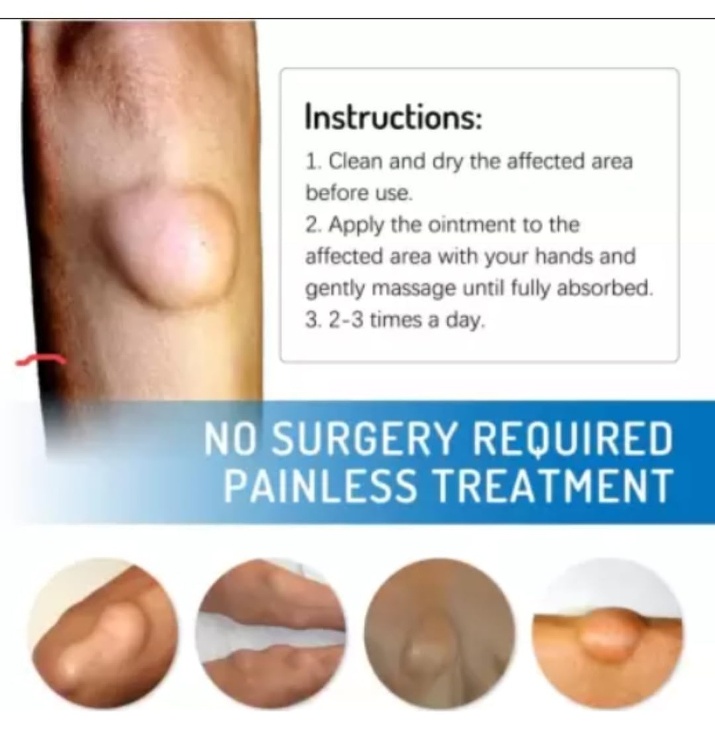 lipoma-removal-cream-mild-easy-to-use-ca-61X6BncHqjL.jpg