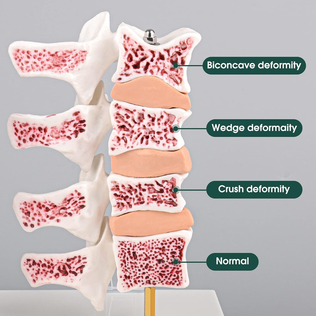 ultrassist-human-anatomy-osteoporosis-mo-3.jpg