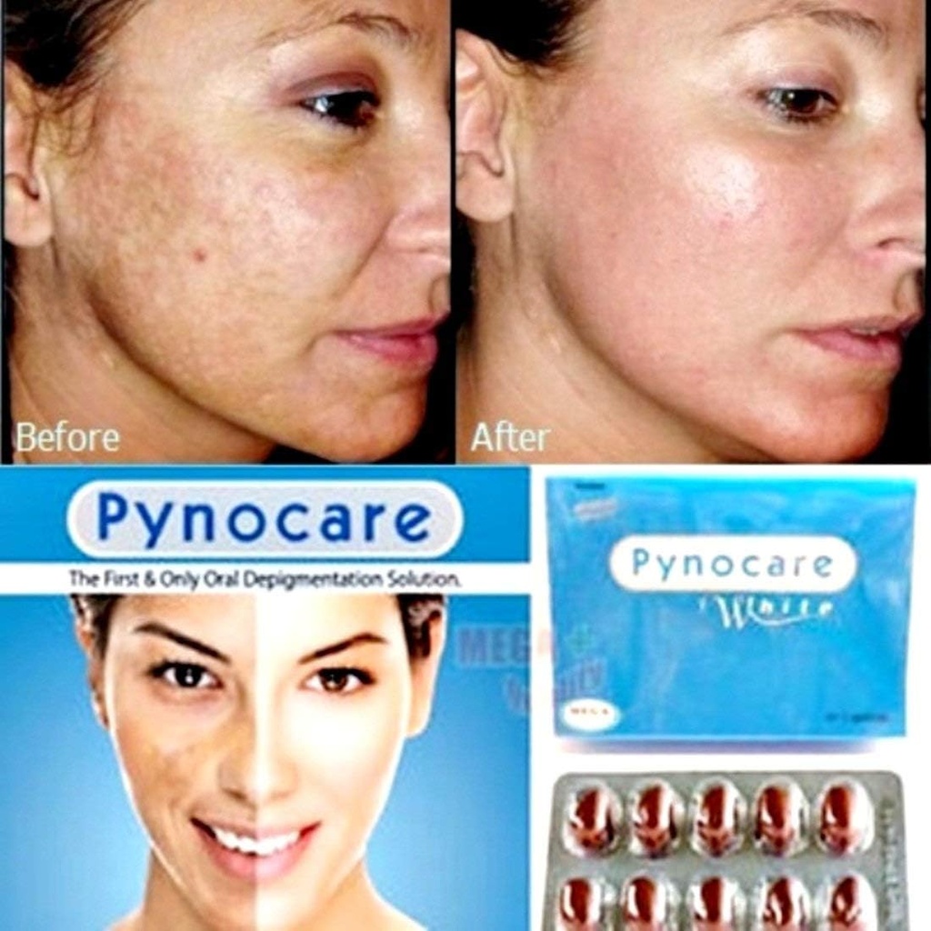 pynocare-white-treatment-of-melasma-20-c-3.jpg