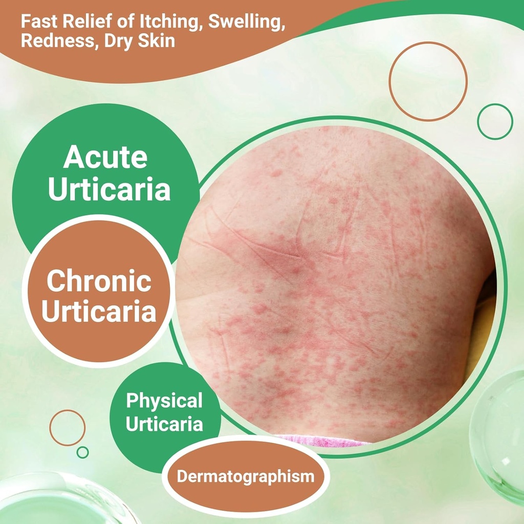 urticaria-cream-hives-relief-advanced-fo-2.jpg