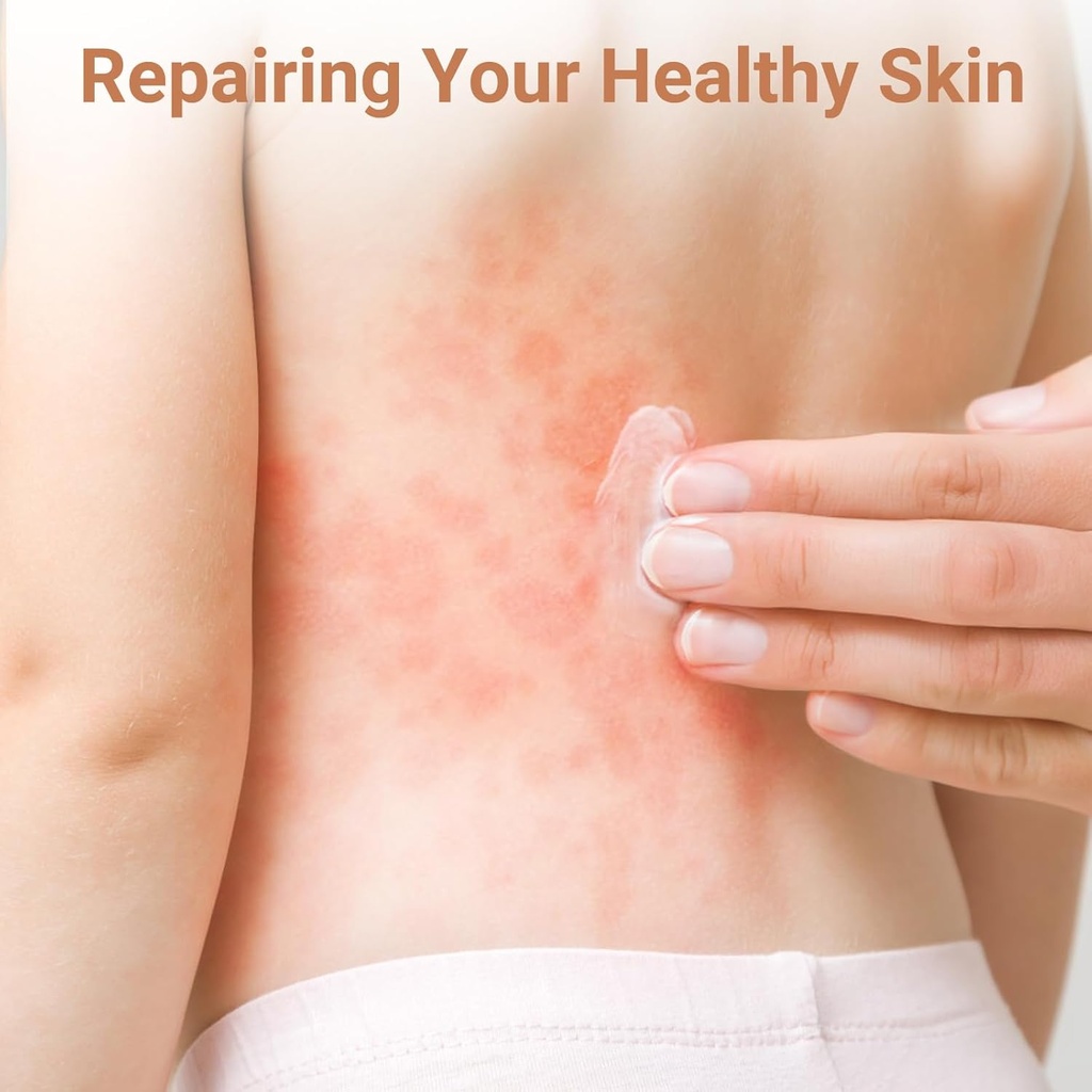 urticaria-cream-hives-relief-advanced-fo-3.jpg