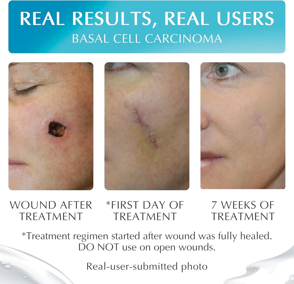newgel-plus-scar-gel-by-mynewgel-advance-3.jpg