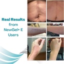 newgel-plus-scar-gel-by-mynewgel-advance-6.jpg