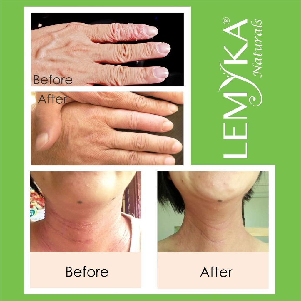 natural-eczema-cream-itch-relief-for-ato-4.jpg