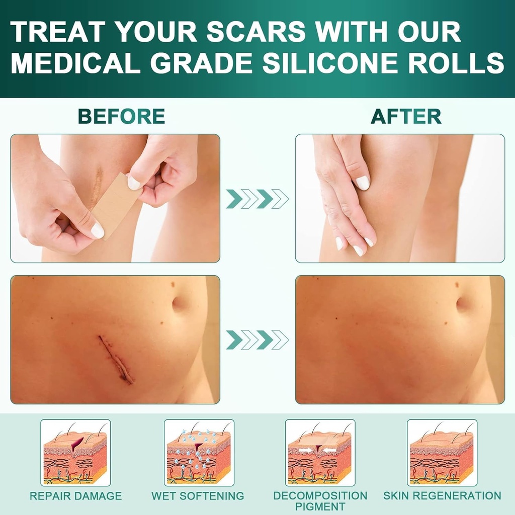 silicone-scar-sheets-silicone-scar-tape--2.jpg