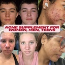 acnetame-acne-pills-vitamin-supplements--2.jpg